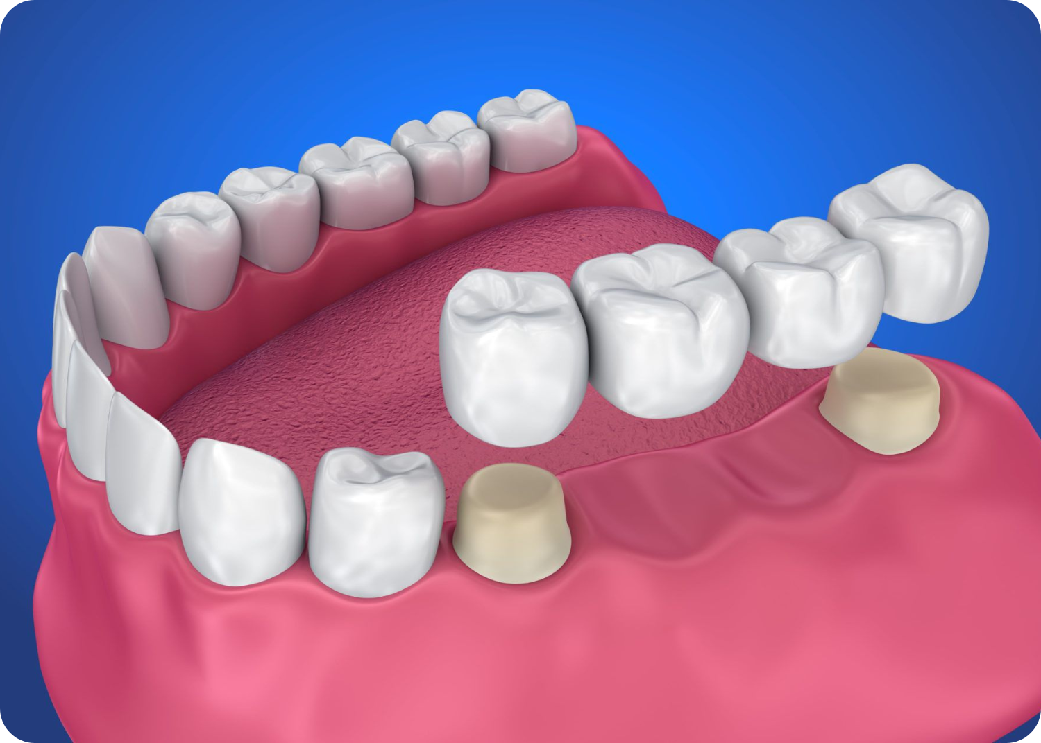 Crown and bridges treatment kharadi
