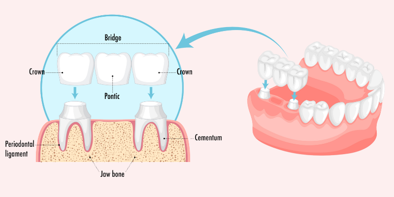 Dental Crowns and Bridges