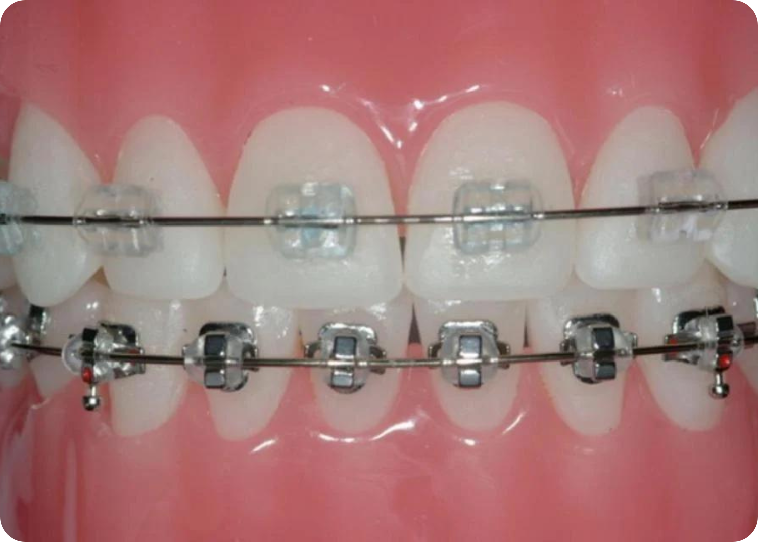 Orthodontic braces