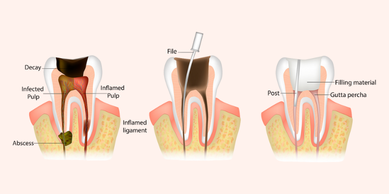 Root canal treatment