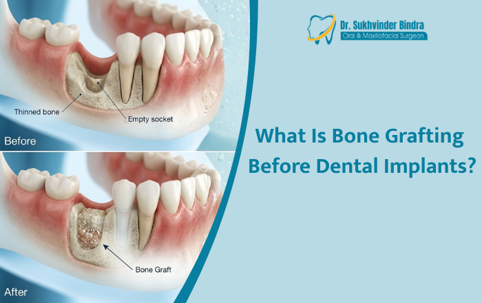 What Is Bone Grafting Before Dental Implants?
