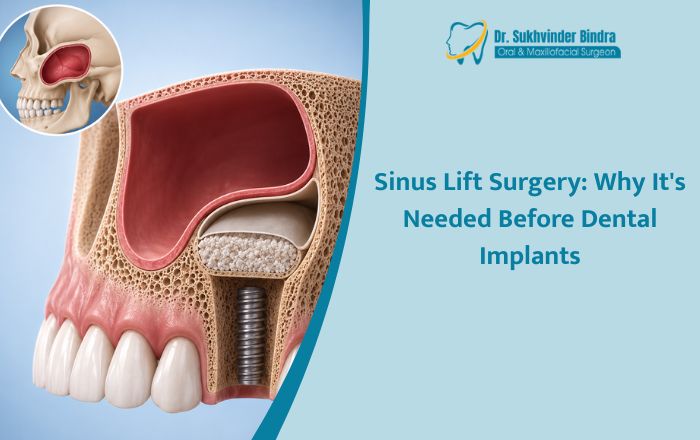 Sinus Lift Surgery: Why It's Needed Before Dental Implants