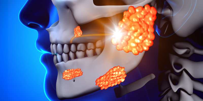 Jaw Cysts & Tumors