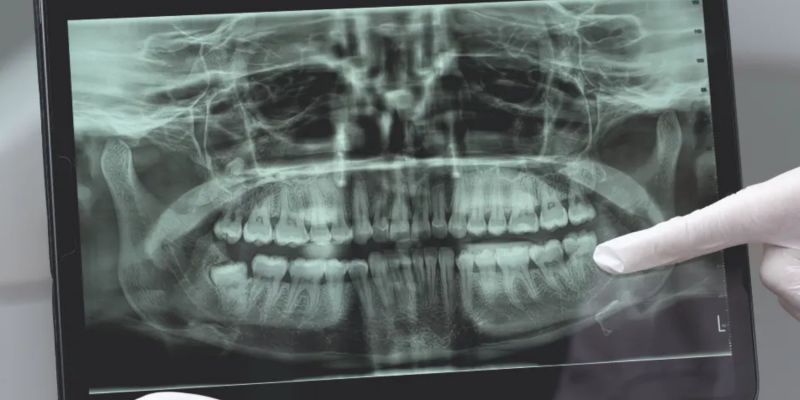 Maxillofacial Fractures