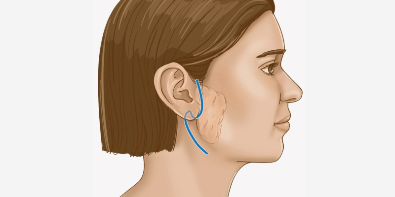 Salivary Gland Surgery in Secunderabad, Telangana - Dr. Sukhvinder Bindra